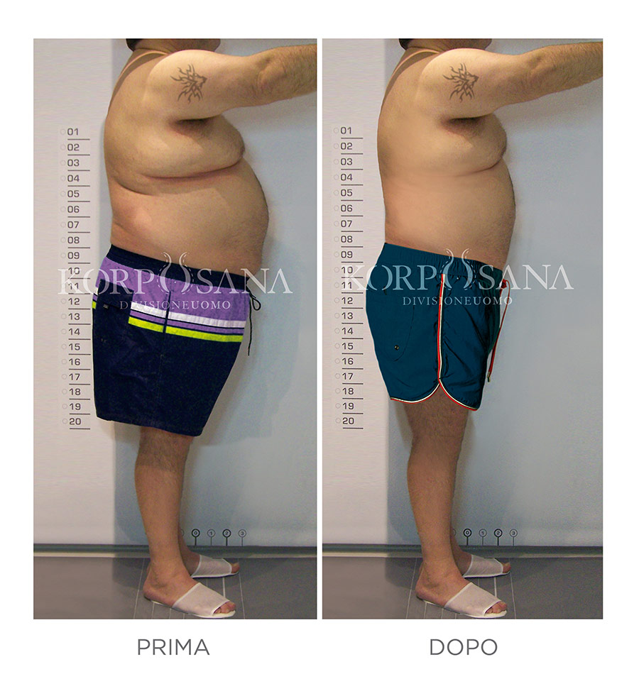 Korposana, Liposuzione senza intervento chirurgico Napoli, Korposana